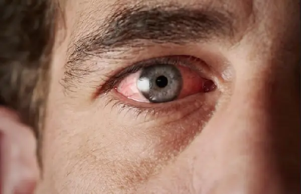 que hacer si presentas ojo rojo signos de alerta y tratamientos
